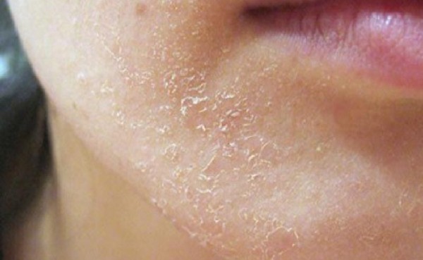 Một số cách khắc phục tình trạng dùng BHA không đẩy mụn trên da