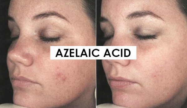 Những hiệu quả mà Azelaic Acid mang đến cho làn da