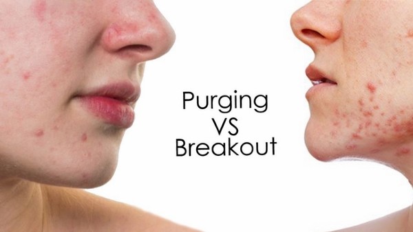 Phân biệt giữa hiện tượng breakout và hiện tượng purging trên da